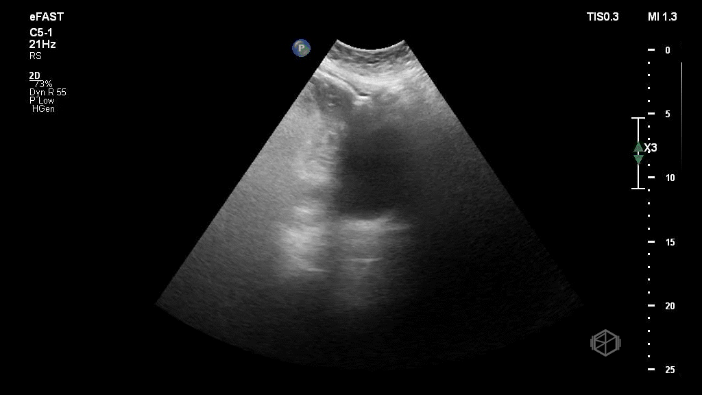 Free fluid and dilated loops of bowel.