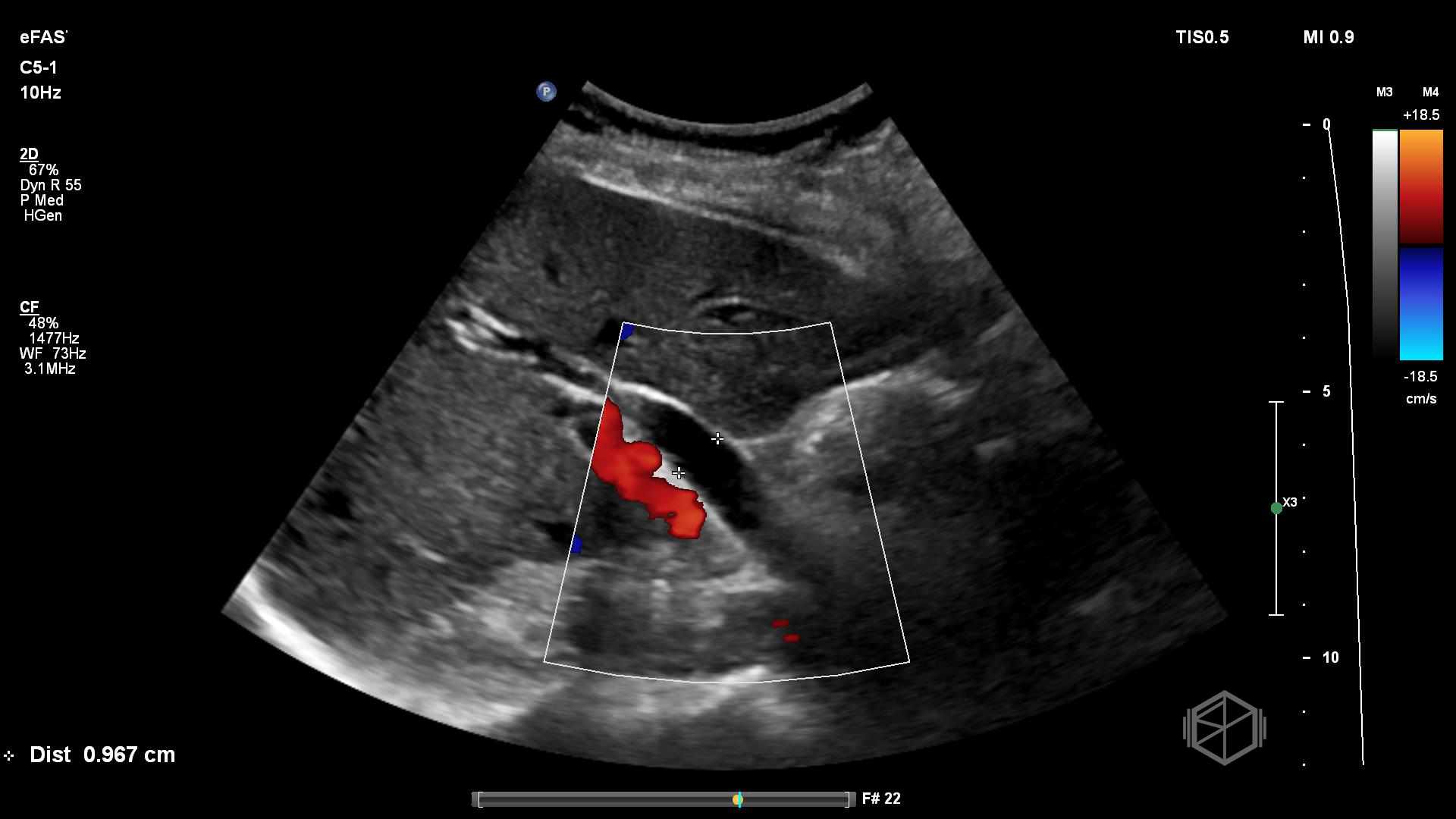 CBD Post-cholecystectomy measurement