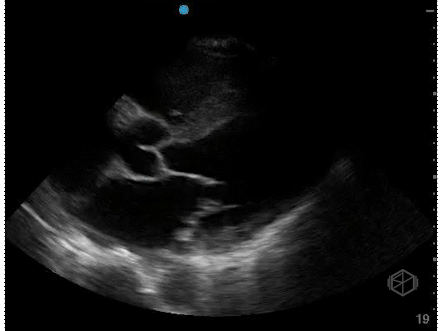Severely hypodynamic LVEF (~15%)