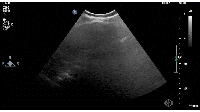Lipliner sign near liver tip