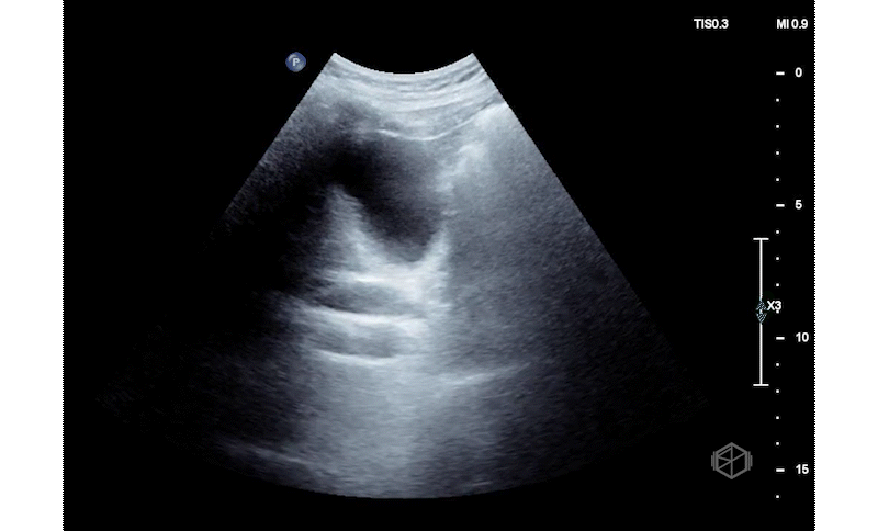 Dilated CBD due to mass at ampulla (adenocarcinoma)