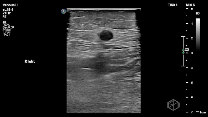 Saphenous vein demonstrating thrombus.