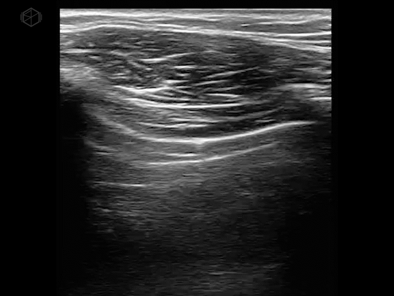 Lung point, pneumothorax