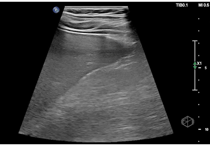 Focal fatty sparing