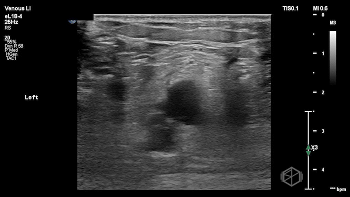 Popliteal vein DVT, notice the popliteal sciatic nerve on top, and the popliteal artery deeper, and the popliteal vein with slightly echogenic clot in the middle.