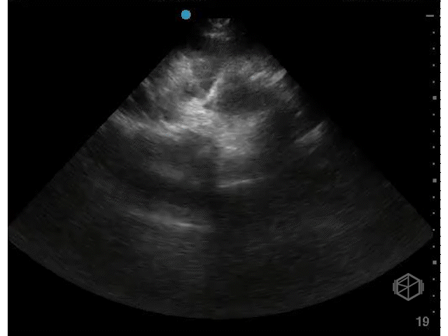+Free fluid in female, transvere view.