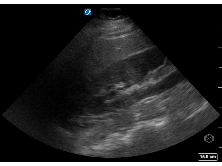 Hepatorenal pouch is negative, however large volume of free fluid noted at the caudal liver edge.