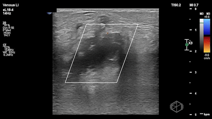Heterogenous appearing Baker's cyst, demonstrating no internal flow.