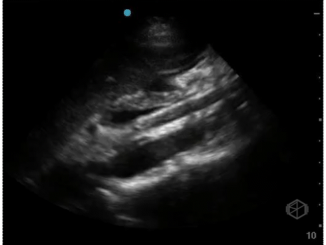 Longitudinal view of the aorta, normal