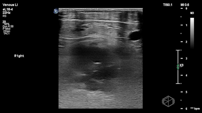 Lymph node mimicking a DVT.