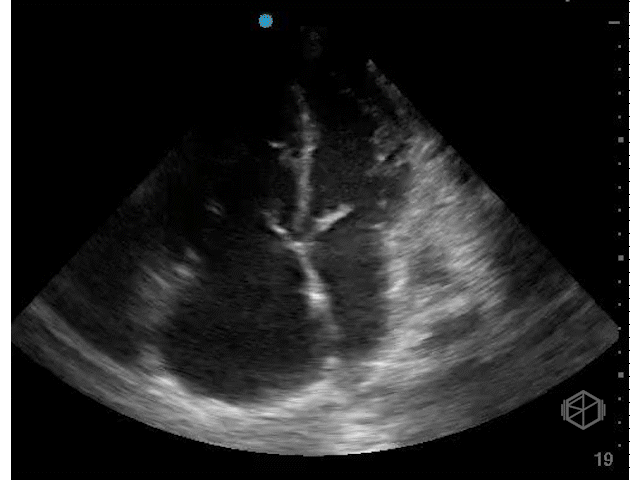 Septal displacement toward LV during diastole — RV volume overload.