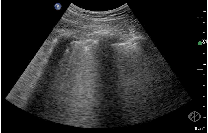 Coalescent B-lines, appear similar to white curtains, or a waterfall. Also note the irregular pleural border.