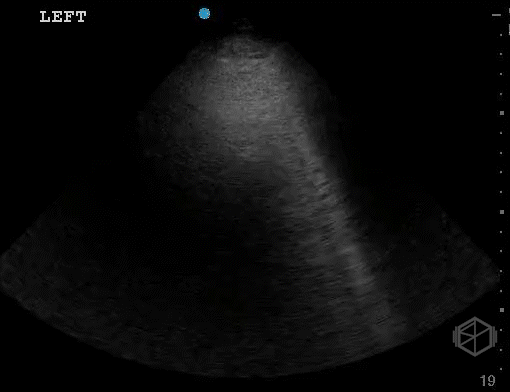 Focal B-lines in minimally affected lung in a patient with pneumonia.