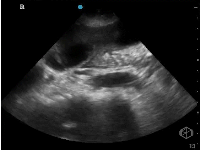 Significantly hydropic gallbladder with multiple other signs of cholecystitis.