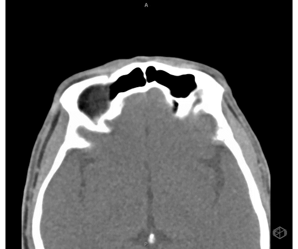 Non-contrast orbital CT congruent with the POCUS diagnosis. This case highlights the value of POCUS in identifying occult globe injury, expediting disposition, and reducing delays in time-sensitive ophthalmologic emergencies.