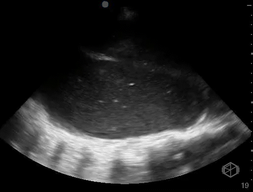 Complex pleural effusion demonstrating a thickened rind consistent with empyema.