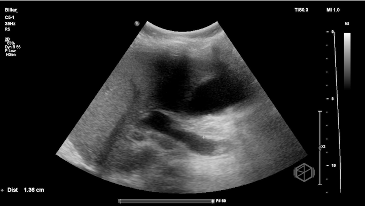 Choledocholithiasis with CBD measurement