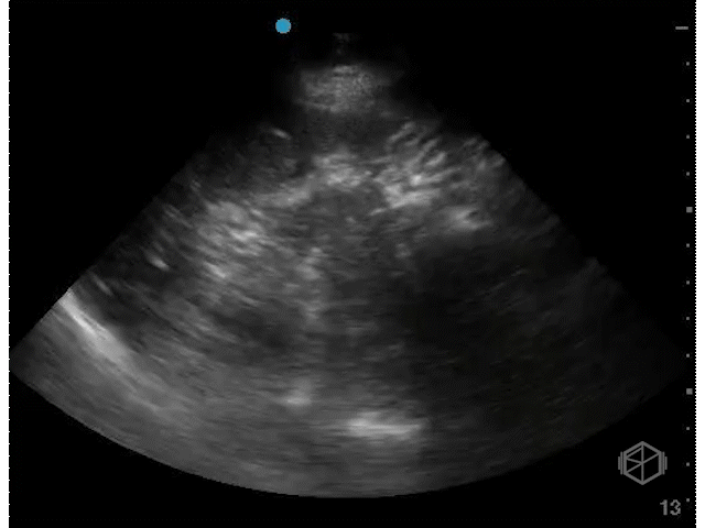 +LUQ splenodiaphragmatic space