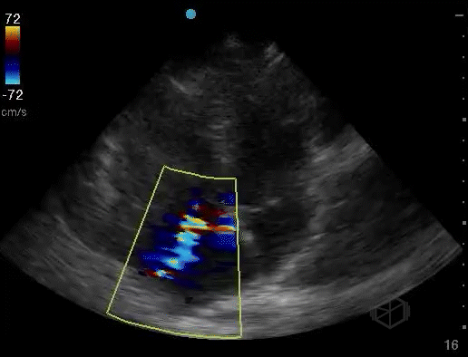 Moderate to Severe Tricuspid Regurgitation