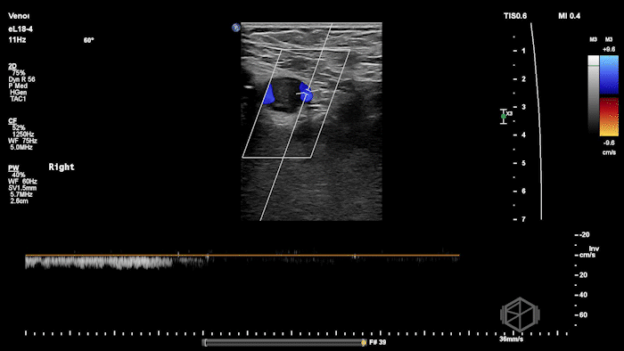 Another example of loss of phasicity on pulse-wave doppler.