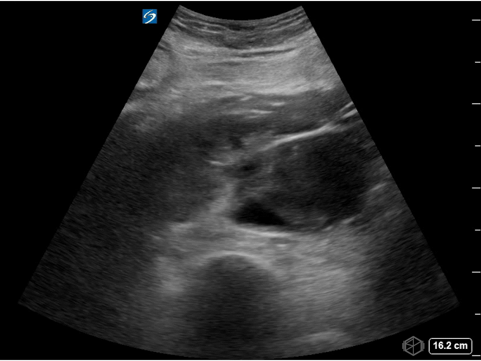 AAA actively leaking into a thrombus.