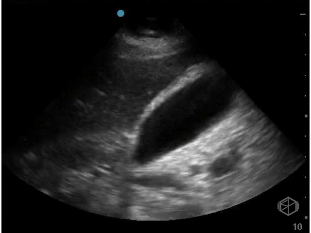 Thickened gallbladder wall