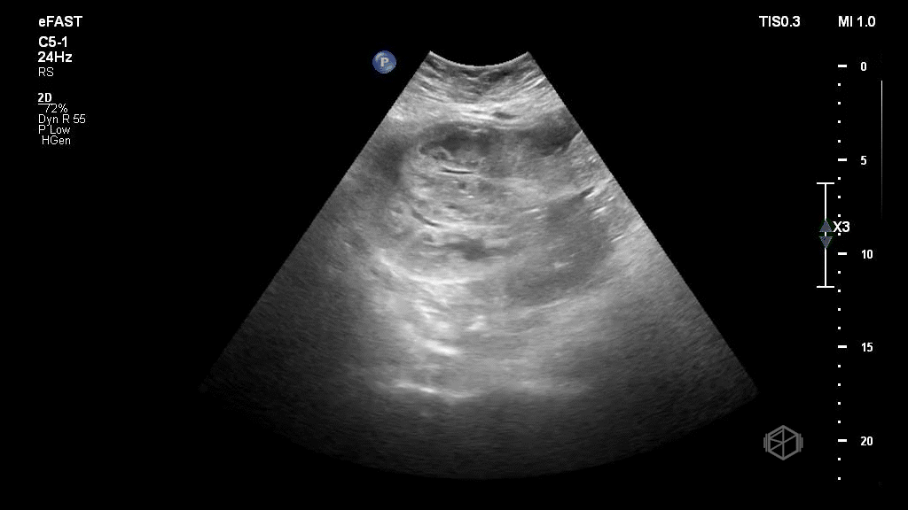 Dilated loops of bowel with bowel wall edema and free fluid.