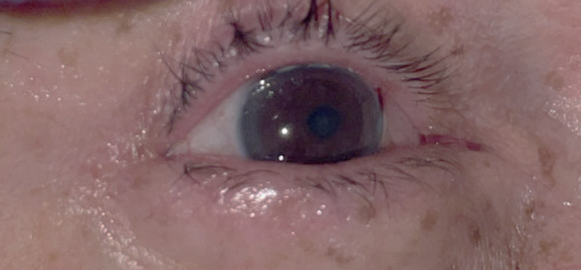Faint wound near the 2 o’clock position of an otherwise normal-appearing right eye, which could be mistaken for a superficial injury. Given the concerning mechanism, POCUS was performed.
