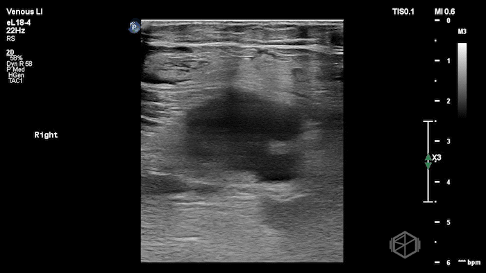 Multiple lymph nodes visible superficially as well as next to the CFV.