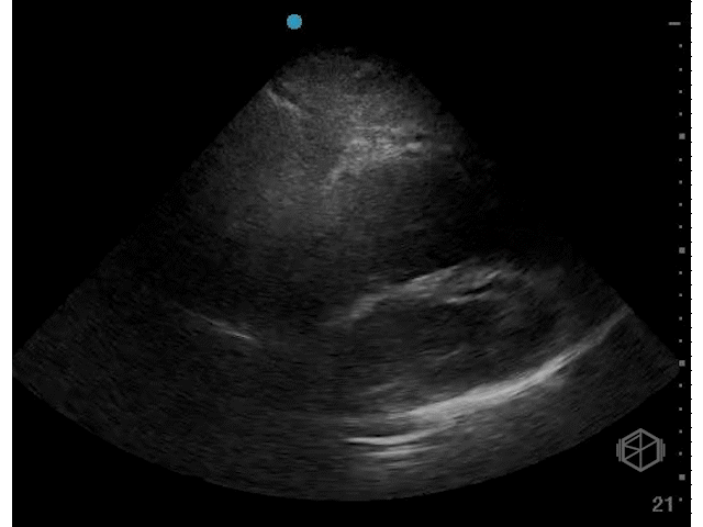 Septal displacement — RV pressure overload (PE)