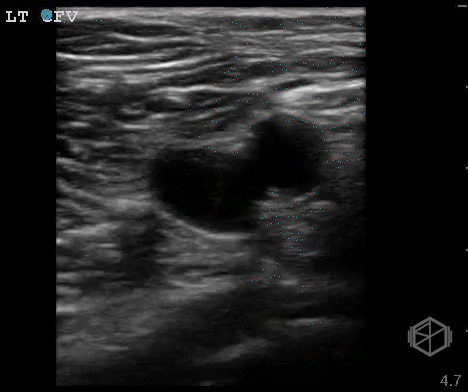 Common femoral vein compression ultrasound, normal