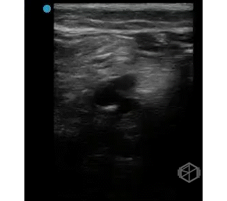 Leg Trifurcation Compression, Normal