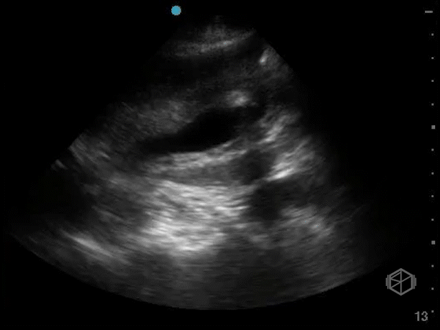 Diffuse gallbladder wall from CHF