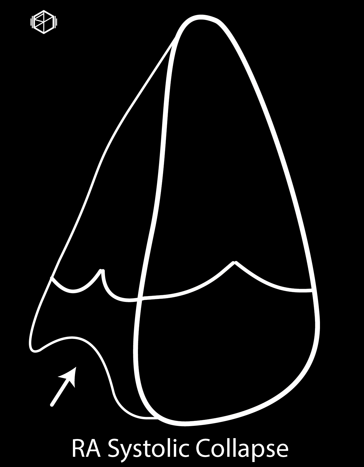 TamponadeHeartRASystolicCollapse-01_10.png