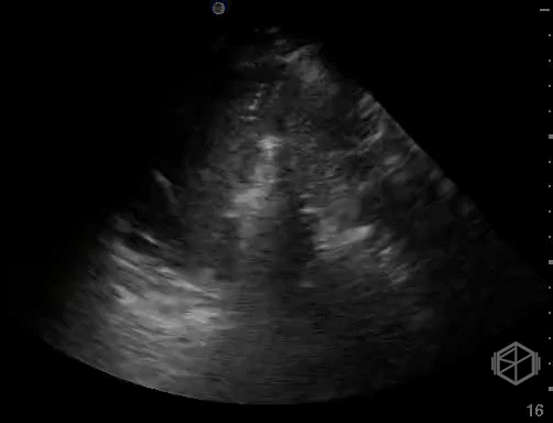 Dynamic air bronchograms — note the movement of the fluid with respiration within the bronchioles.