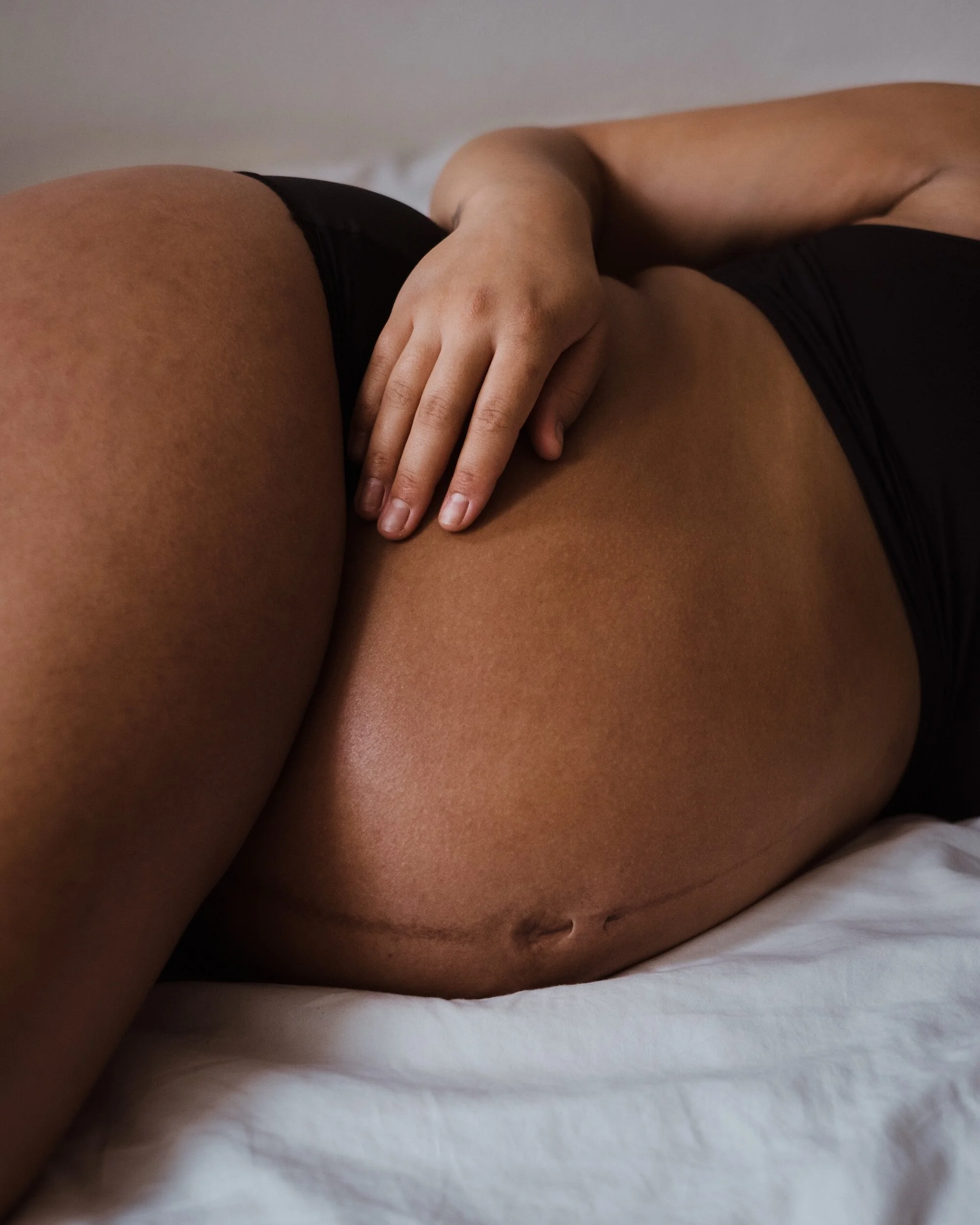 Close-up of a person lying on their side, wearing black underwear, with their hand resting on their hip, showing a stretch mark on their thigh and a scar on their abdomen.