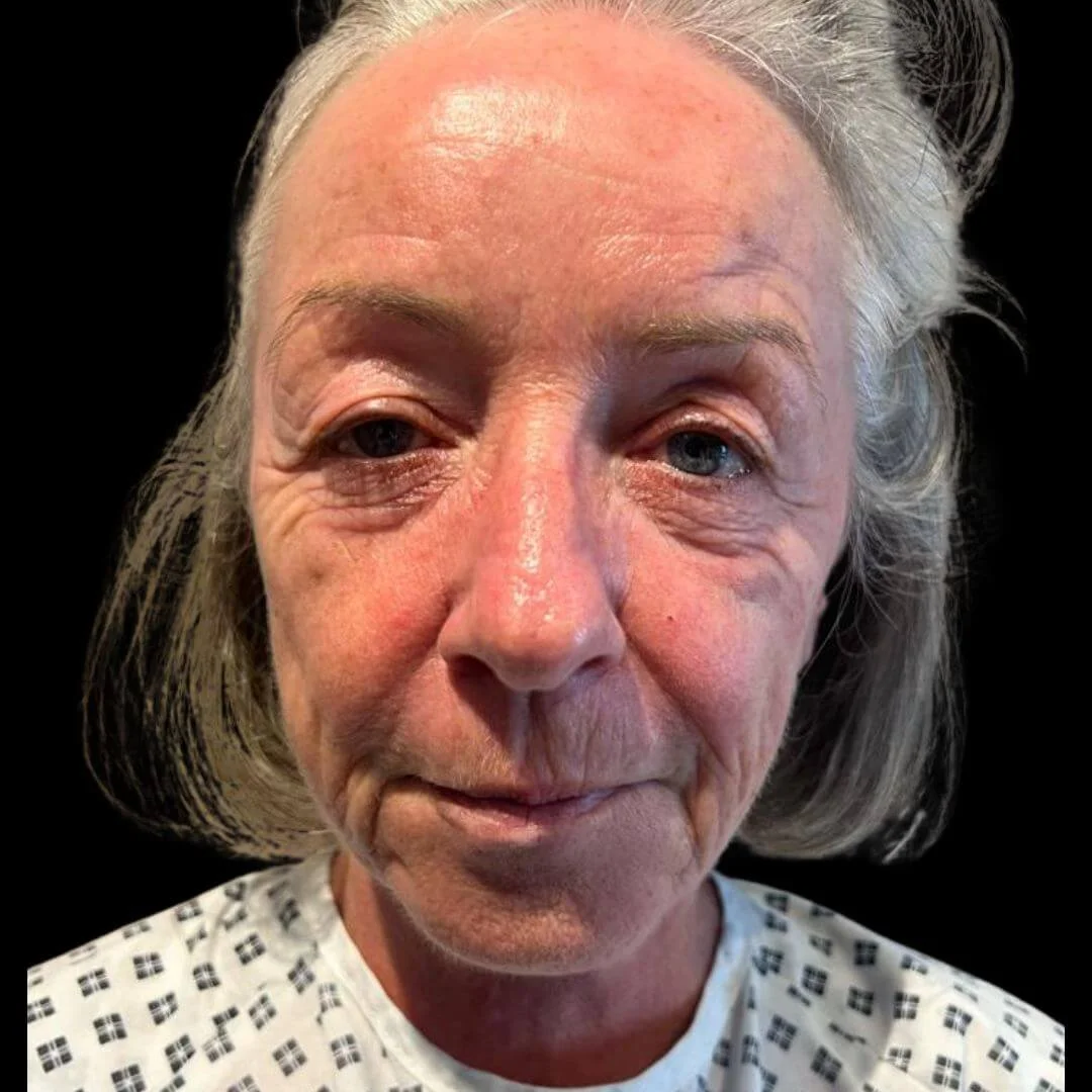 Upper Blepharoplasty before and after, before image