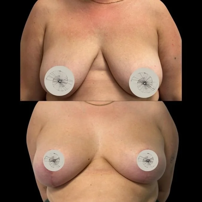 Breast Reduction before and after done by Miss Jurga Pikturnaite