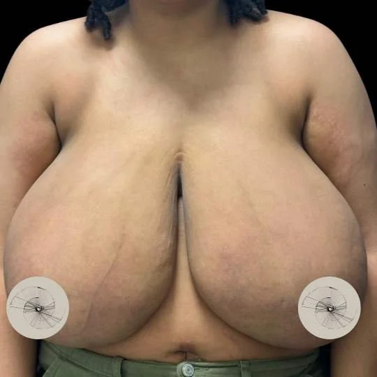 Gigantomastia Reduction Before performed by Jurga Pikturnaite, female plastic surgeon