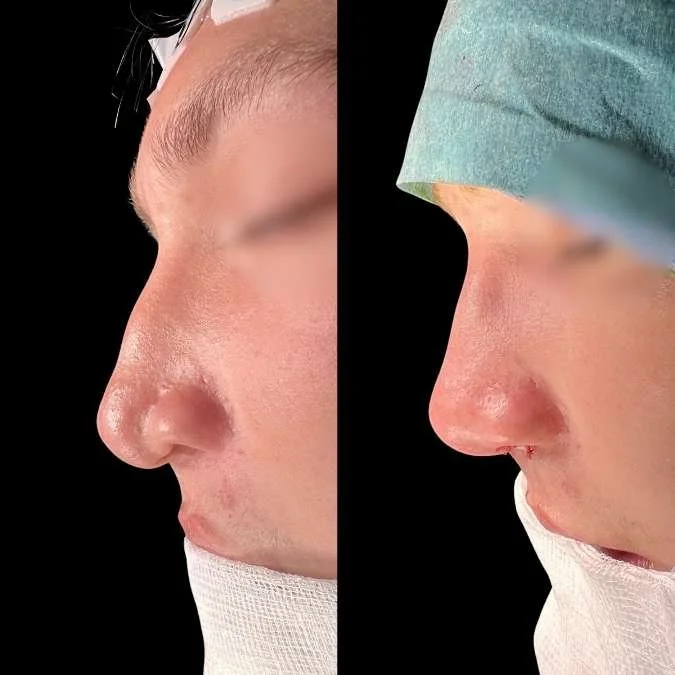 Cleft Septorhinoplasty - GA Rhinoplasty Page.jpg