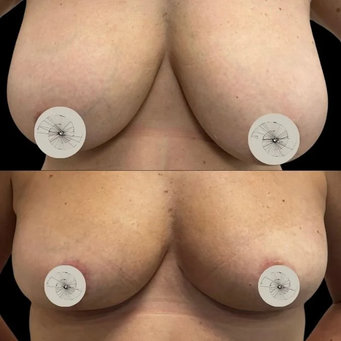 Before and After Breast Reduction
