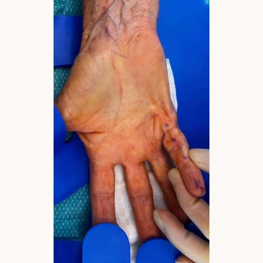 pre-operative picture for Dupuytren's Contracture Correction