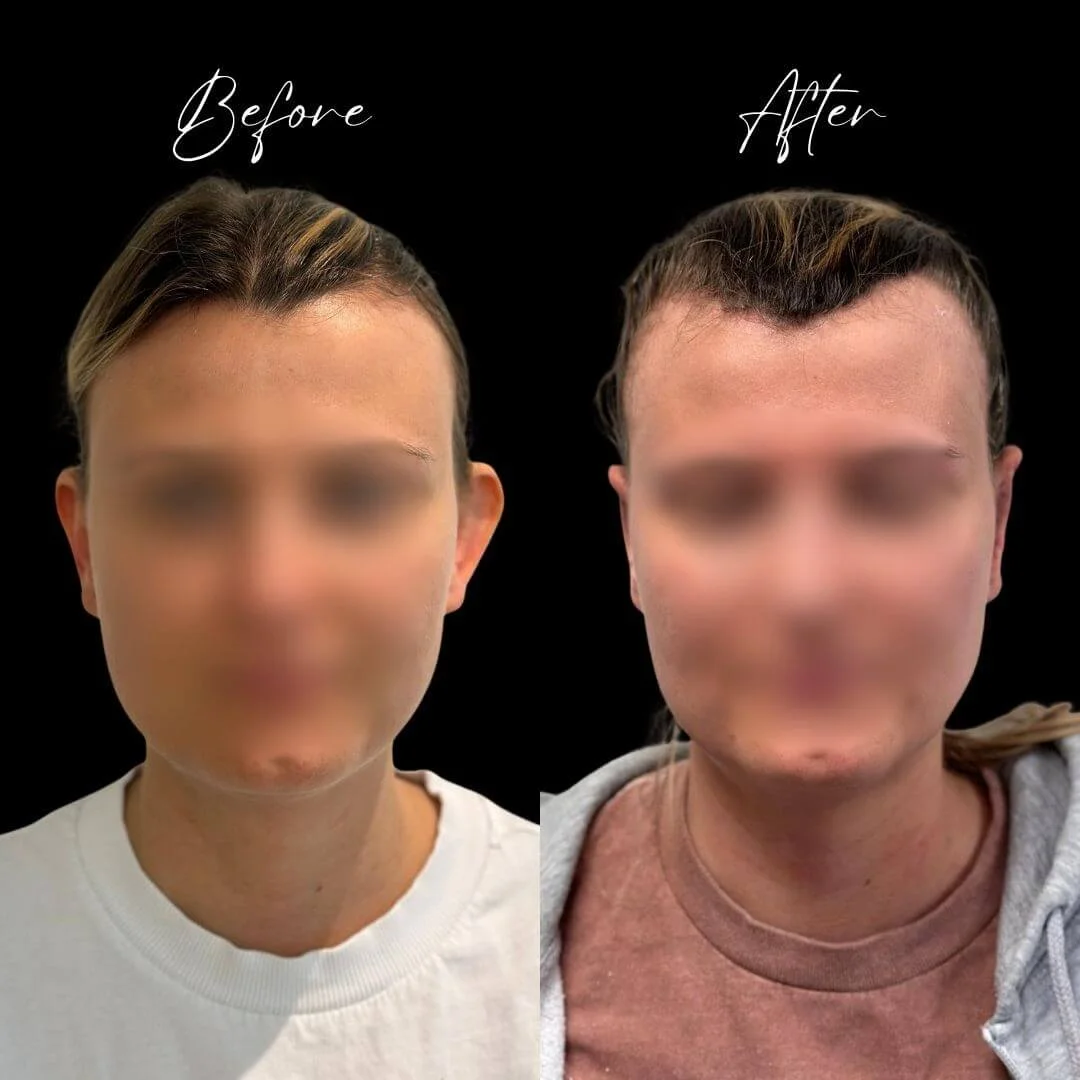 Before and After ear pinning surgery with Miss Jurga Pikturnaite, female plastic otoplasty surgeon