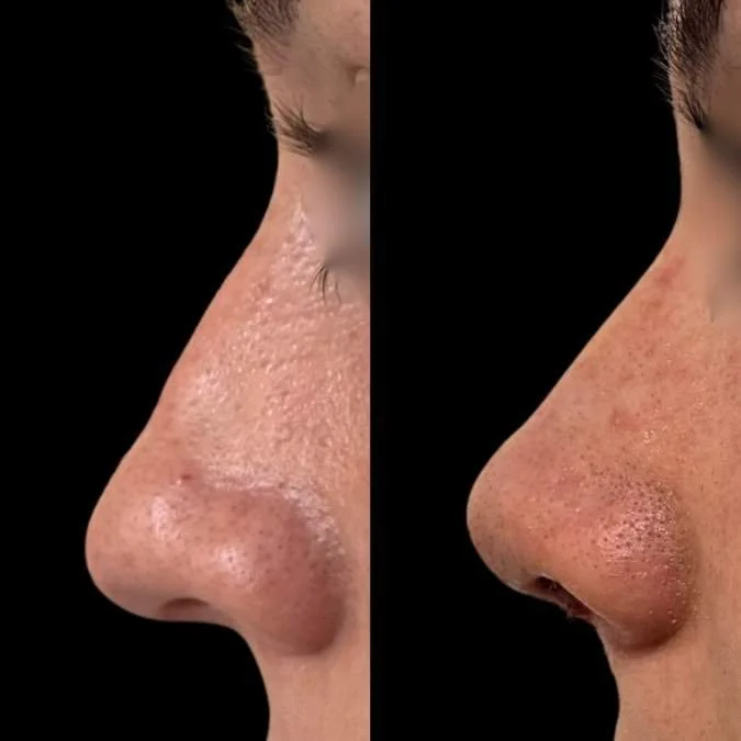 Before and After Nose Job