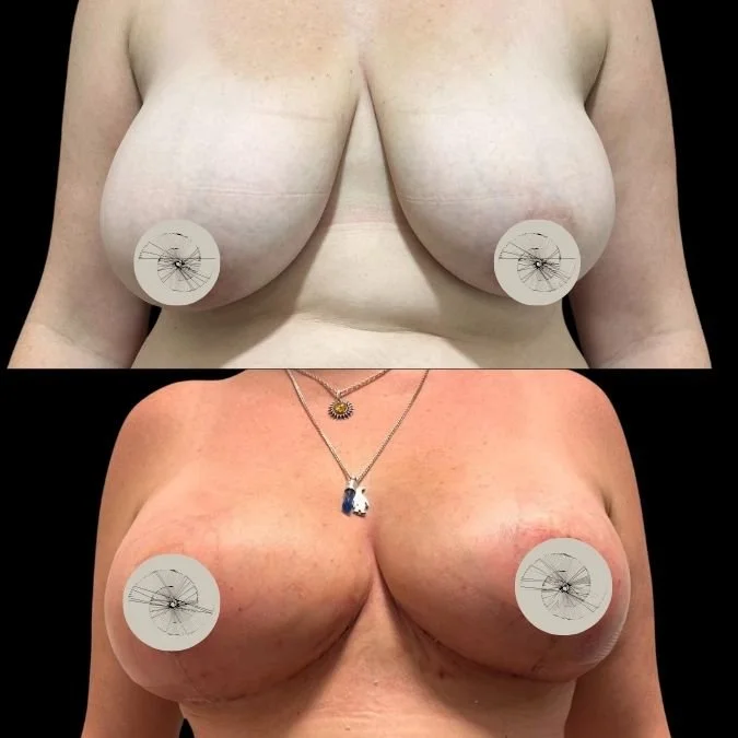 Before and After Breast Lift