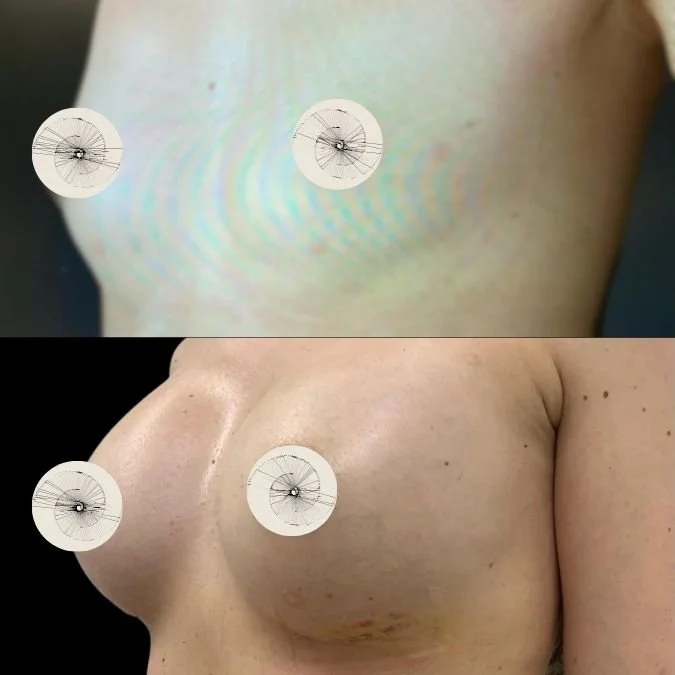 Before and After Breast Augmentation - Boob Job Results.