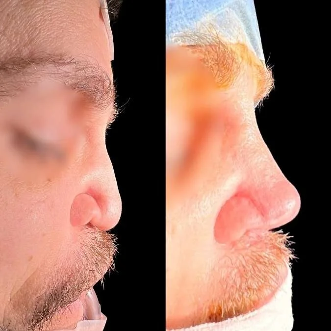 Septorhinoplasty - GA Rhinoplasty Page.jpg