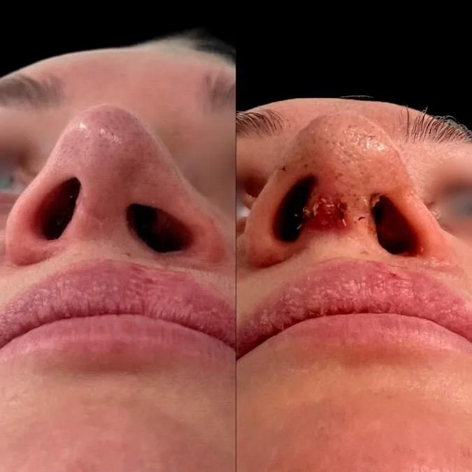 Before and After Secondary Cleft Septorhinoplasty