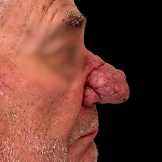 Close-up side profile of an older man with a large, bulbous, textured nose and blurred eye, against a black background.