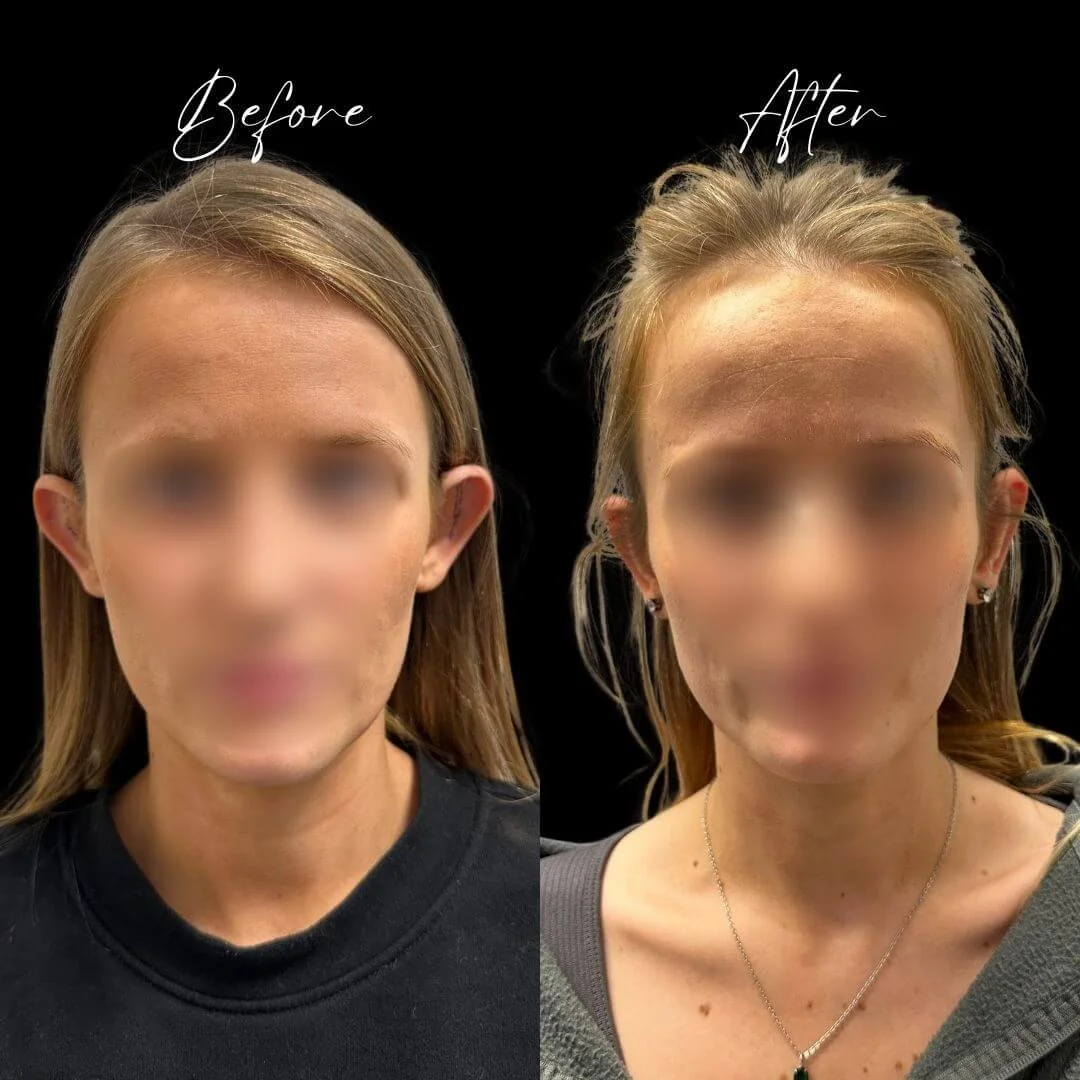Otoplasty surgery results of Miss Jurga Pikturnaite, female plastic otoplasty surgeon